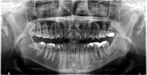 初診時　歯のレントゲン